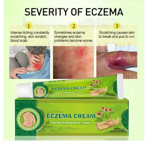 Crème anti-eczéma et antifongique